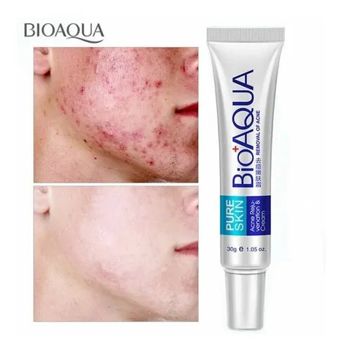 Crema Anti-Acné Bioaqua – Transformación Completa para Piel Grasa y Cicatrices